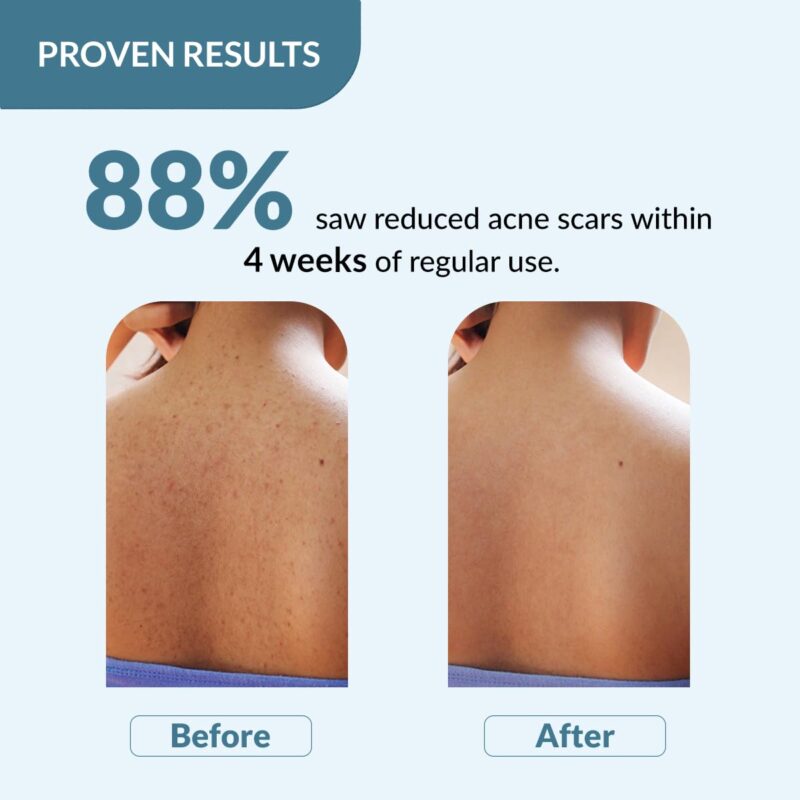 4x FIXDERMA Salyzap 2% Salicylic Acid Body Wash - 200ml each (Pack of 4) - Image 6